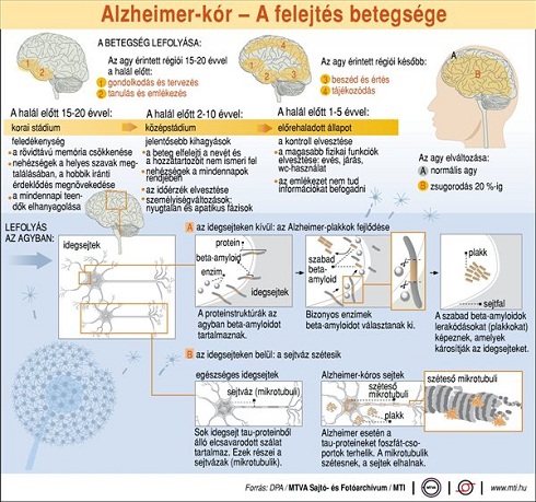 Alzheimer-kór: a felejtés betegsége; a betegség lefolyása; lefolyás az agyban, az agy érintett régiói, ismertető ábra