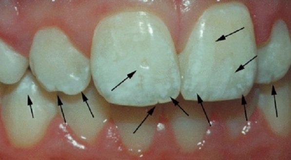 Fluor okozta károsodás a fogzománcon.